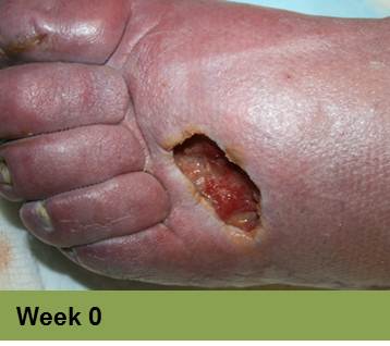 Type 2 diabetes surgical treatment